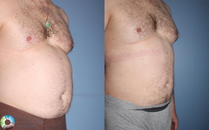 Before & After Power-assisted Liposuction Case 825 View #3 View in Golden, CO