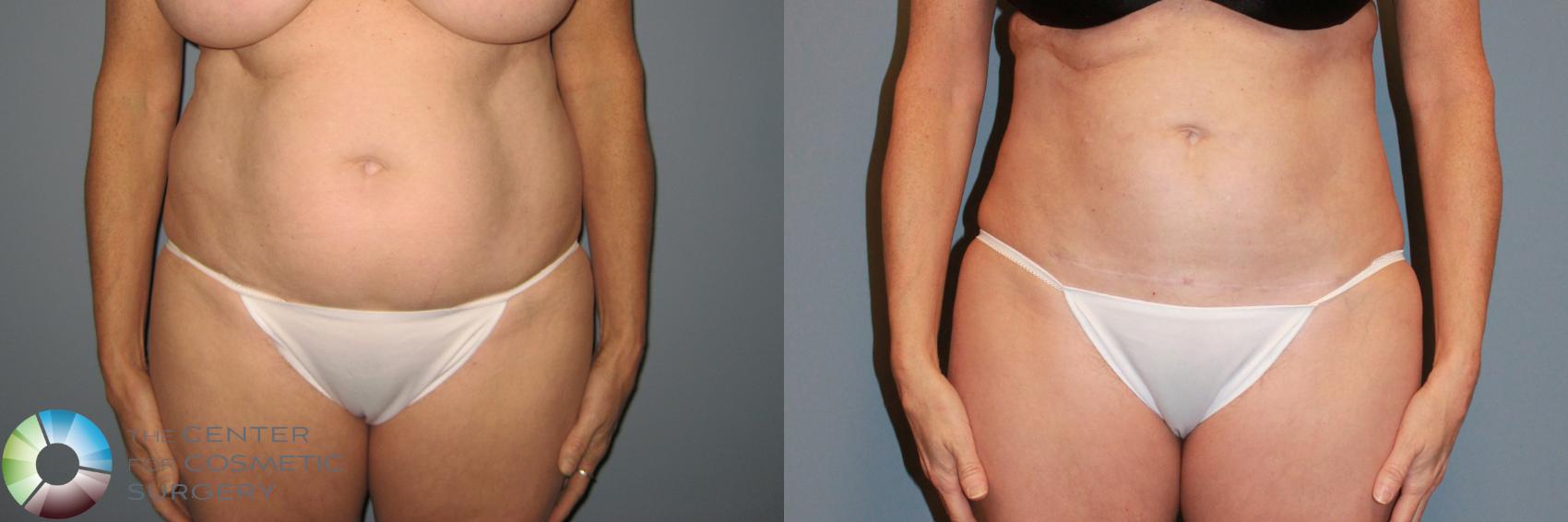 Before & After Power-Assisted Liposuction Case 869 View #1 in Denver and Colorado Springs, CO