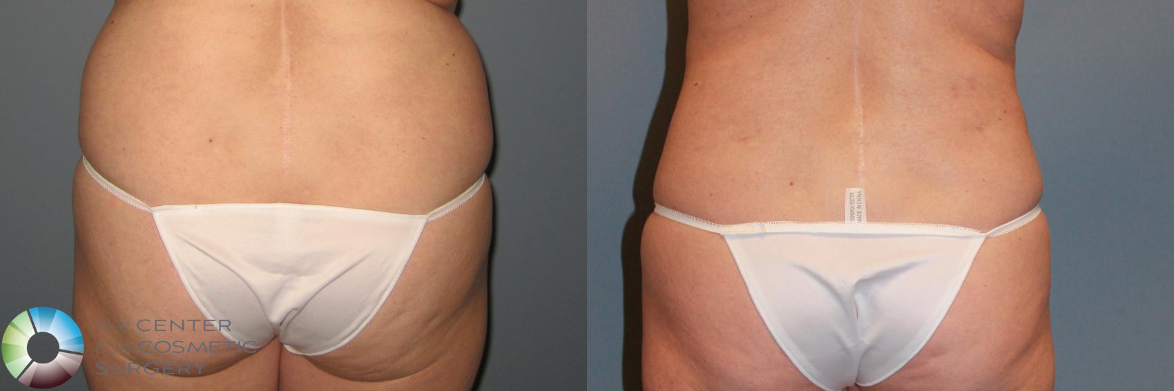 Before & After Power-Assisted Liposuction Case 869 View #2 in Denver and Colorado Springs, CO