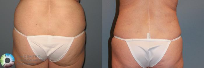 Before & After Power-assisted Liposuction Case 869 View #2 View in Golden, CO