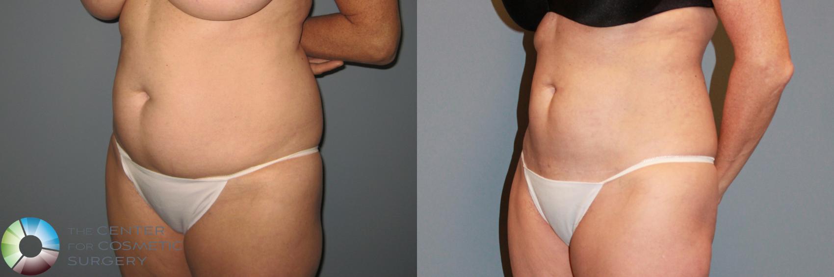 Before & After Power-Assisted Liposuction Case 869 View #3 in Denver and Colorado Springs, CO