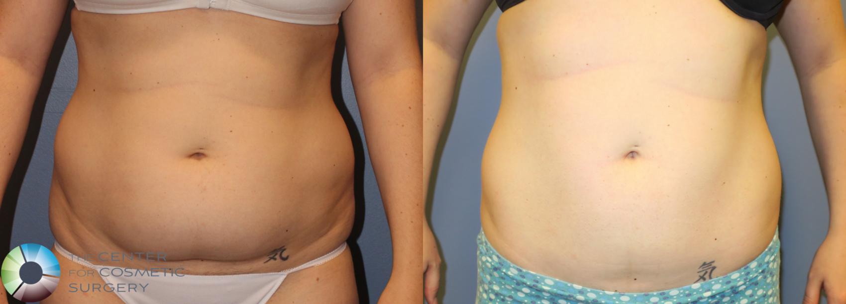 Before & After Power-assisted Liposuction Case 900 View #1 View in Golden, CO
