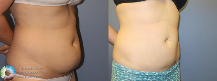 Before & After Power-assisted Liposuction Case 900 View #2 in Denver and Colorado Springs, CO