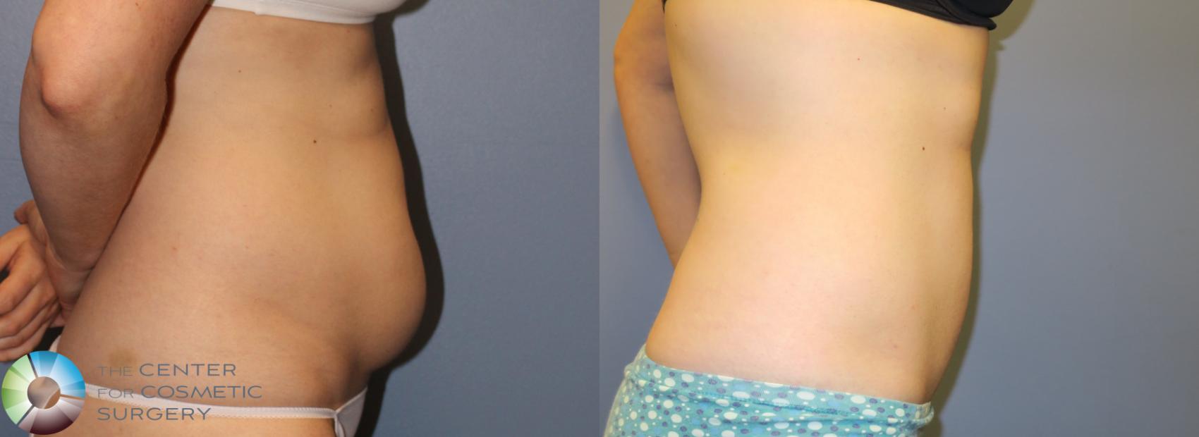Before & After Power-assisted Liposuction Case 900 View #3 View in Golden, CO