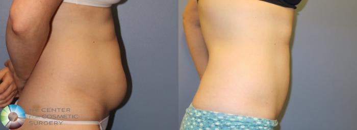 Before & After Power-assisted Liposuction Case 900 View #3 in Denver and Colorado Springs, CO