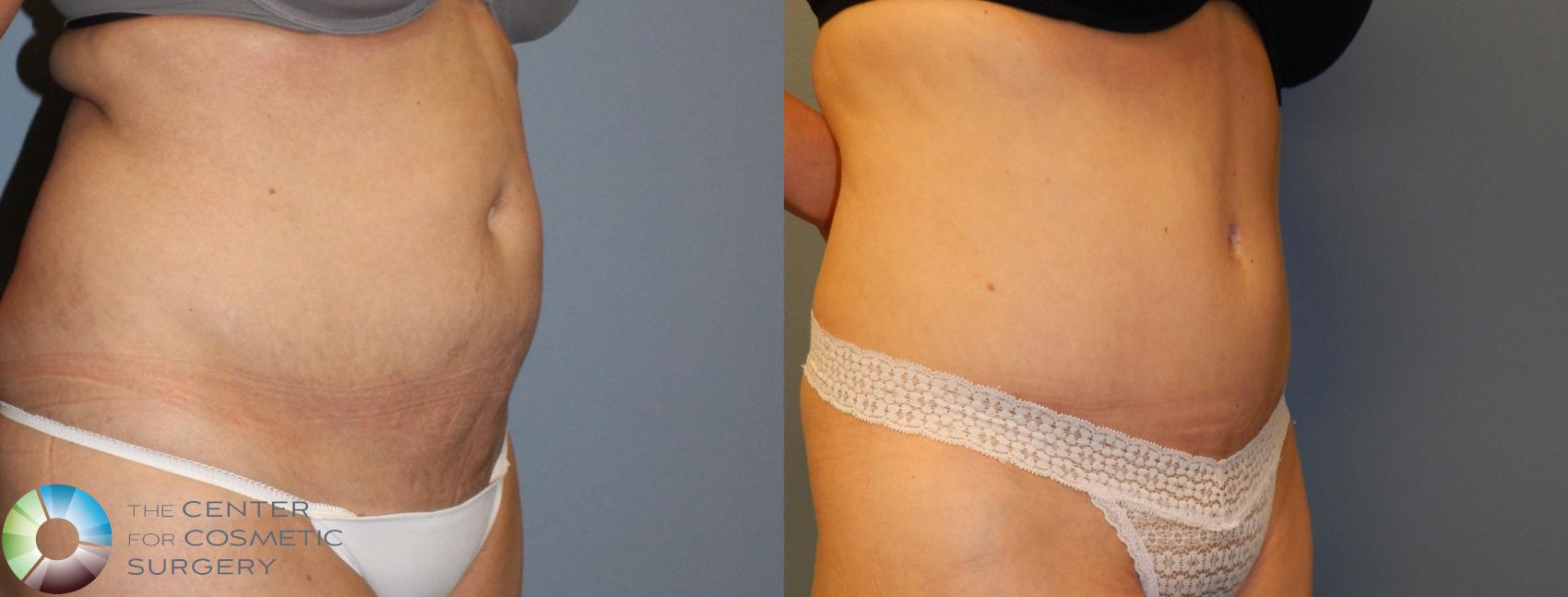 Before & After Power-Assisted Liposuction Case 956 View #1 in Denver and Colorado Springs, CO