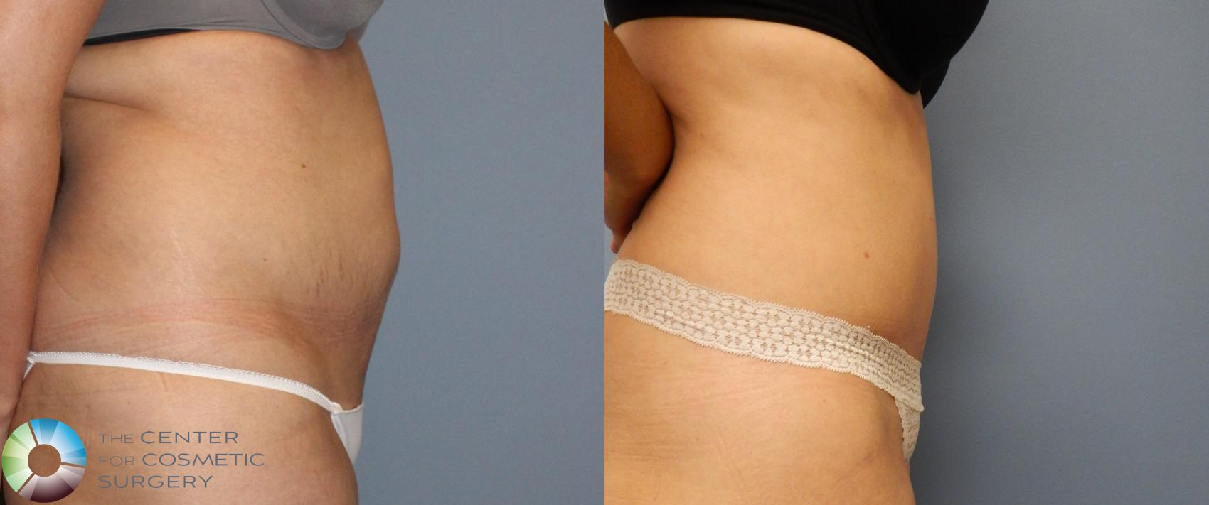 Before & After Power-Assisted Liposuction Case 956 View #2 in Denver and Colorado Springs, CO