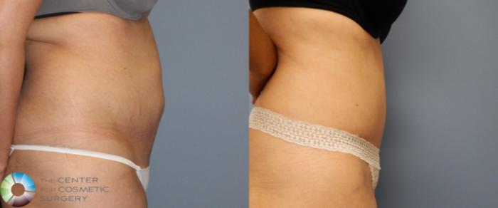 Before & After Tummy Tuck Case 956 View #2 in Denver and Colorado Springs, CO