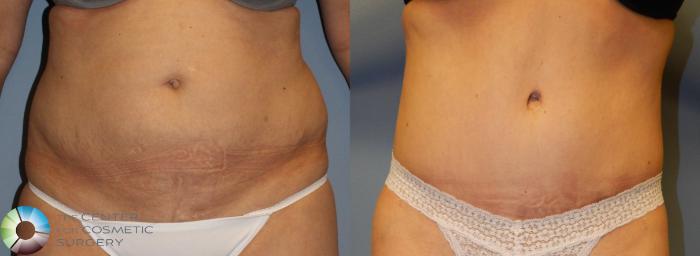 Before & After Tummy Tuck Case 956 View #3 in Denver and Colorado Springs, CO