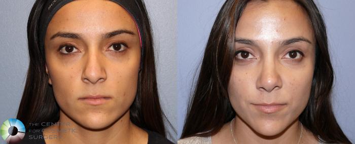 Before & After Rhinoplasty Case 11219 Front in Denver and Colorado Springs, CO