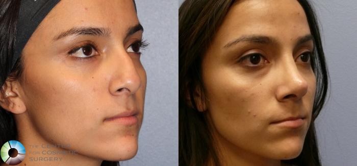 Before & After Rhinoplasty Case 11219 Right Oblique in Denver and Colorado Springs, CO