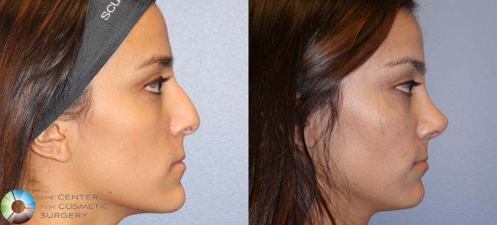 Before & After Rhinoplasty Case 11219 Right Side in Denver and Colorado Springs, CO