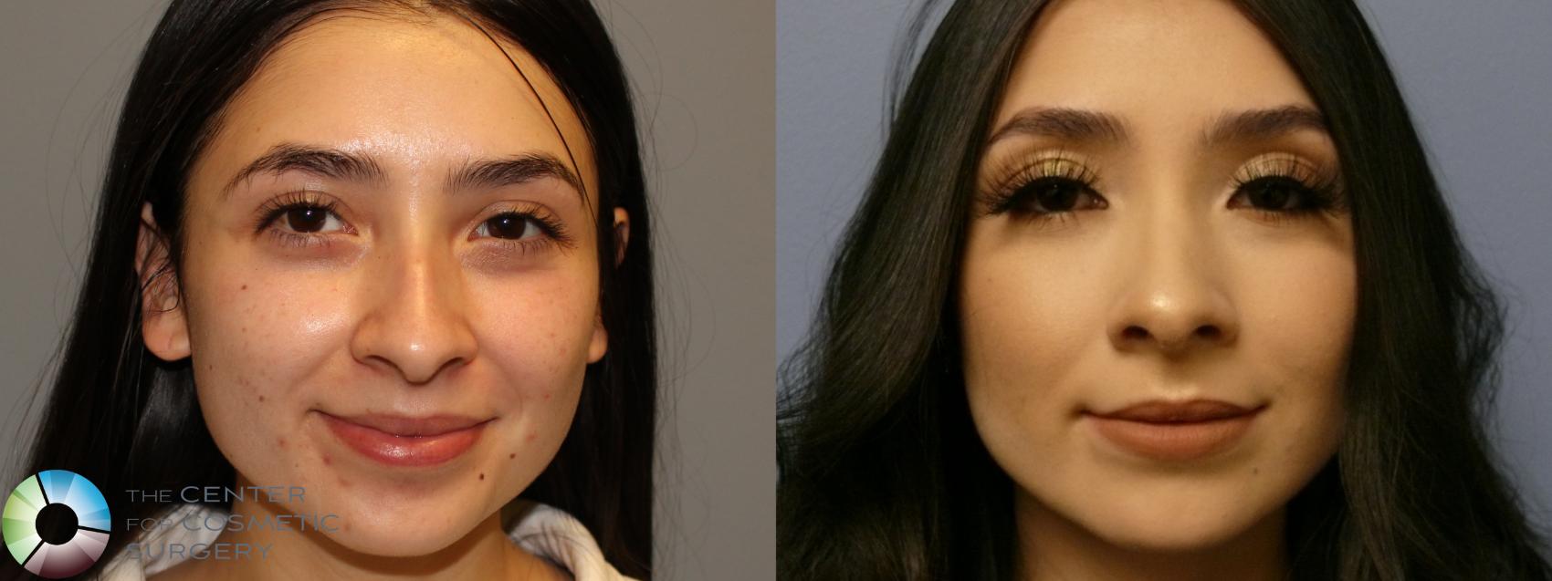 Before & After Rhinoplasty Case 11364 Front in Denver, CO