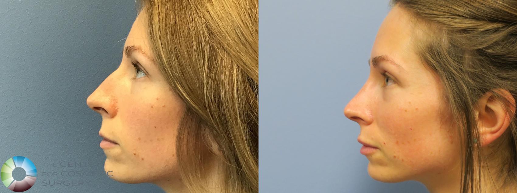 Before & After Rhinoplasty Case 11548 Left Side in Denver and Colorado Springs, CO