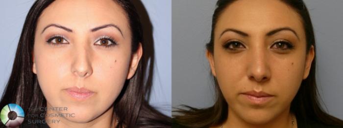Before & After Rhinoplasty Case 11637 Front in Denver and Colorado Springs, CO