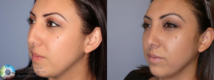 Before & After Rhinoplasty Case 11637 Left Oblique in Denver and Colorado Springs, CO