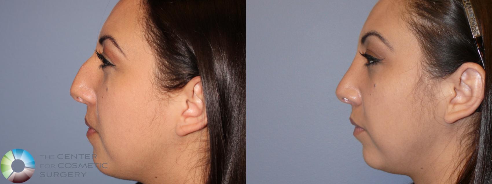 Before & After Rhinoplasty Case 11637 Left Side in Denver and Colorado Springs, CO