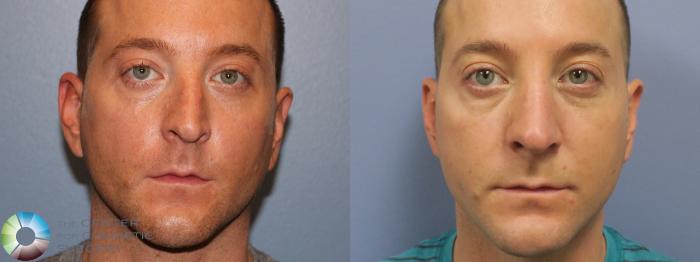 Before & After Rhinoplasty Case 11638 Front View in Golden, CO