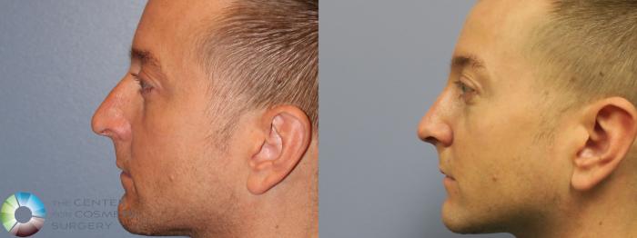 Before & After Rhinoplasty Case 11638 Left Side View in Golden, CO