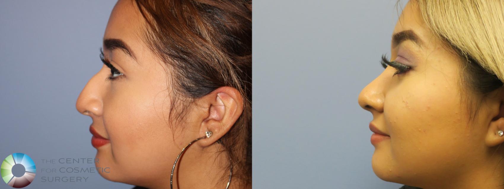 Before & After Rhinoplasty Case 11639 Left Side View in Golden, CO