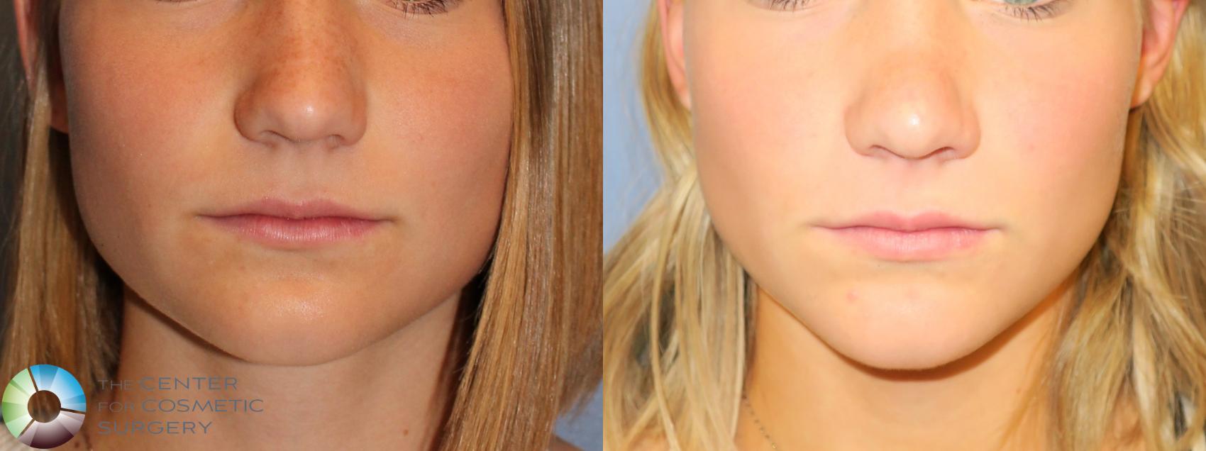 Before & After Rhinoplasty Case 11657 Front View in Golden, CO