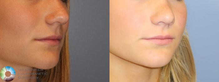 Before & After Rhinoplasty Case 11657 Right Oblique View in Golden, CO