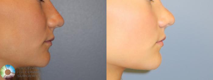 Before & After Rhinoplasty Case 11657 Right Side View in Golden, CO