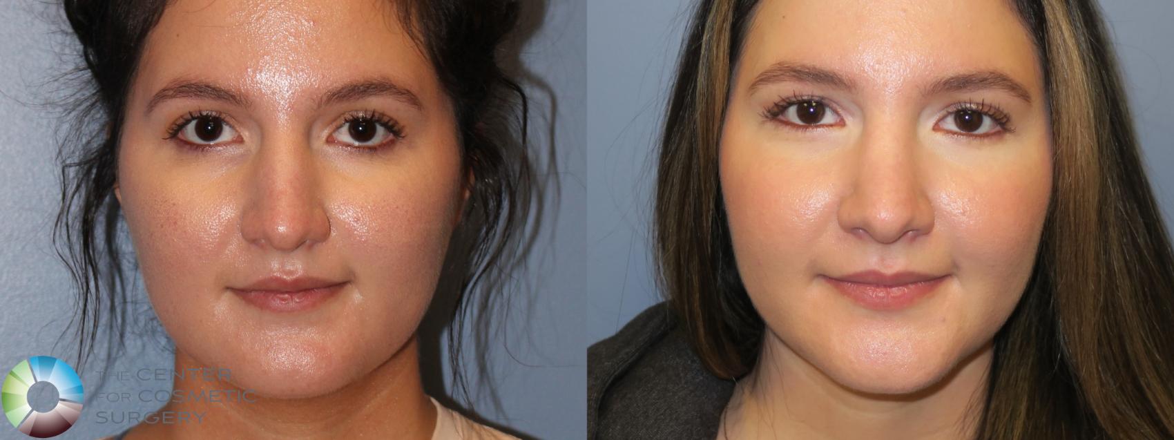 Before & After Rhinoplasty Case 11658 Front in Denver and Colorado Springs, CO