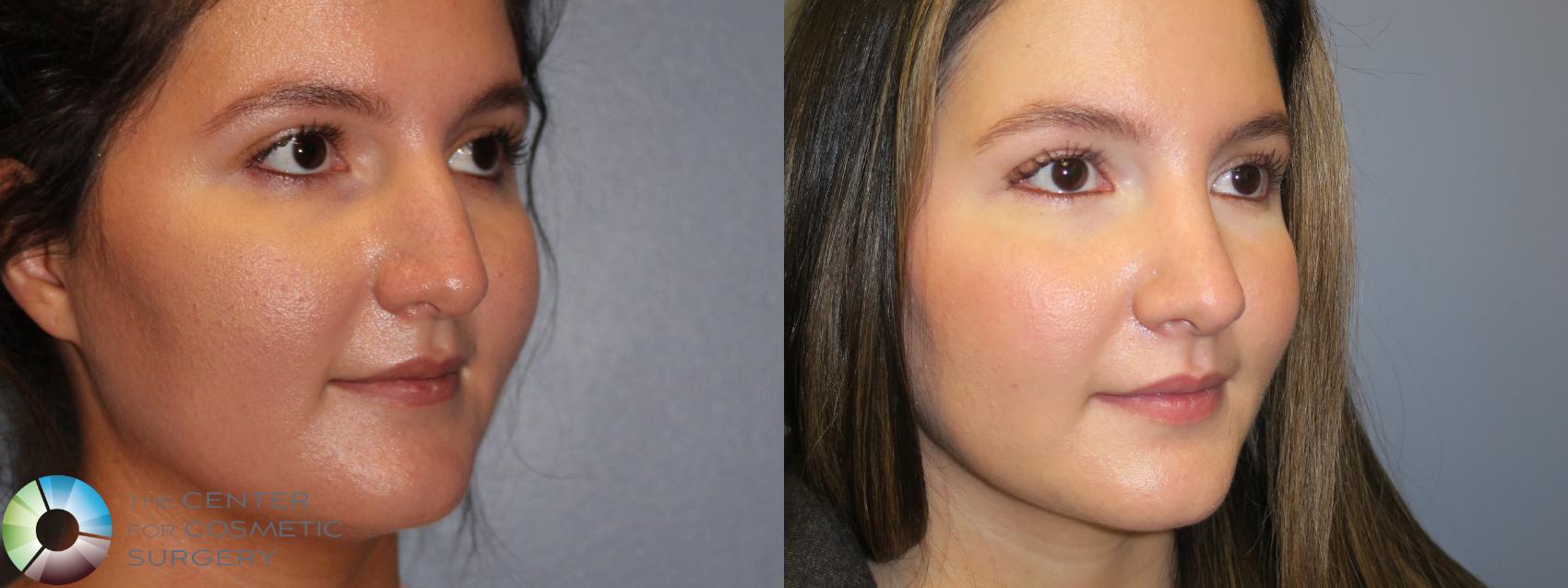 Before & After Rhinoplasty Case 11658 Right Oblique in Denver and Colorado Springs, CO