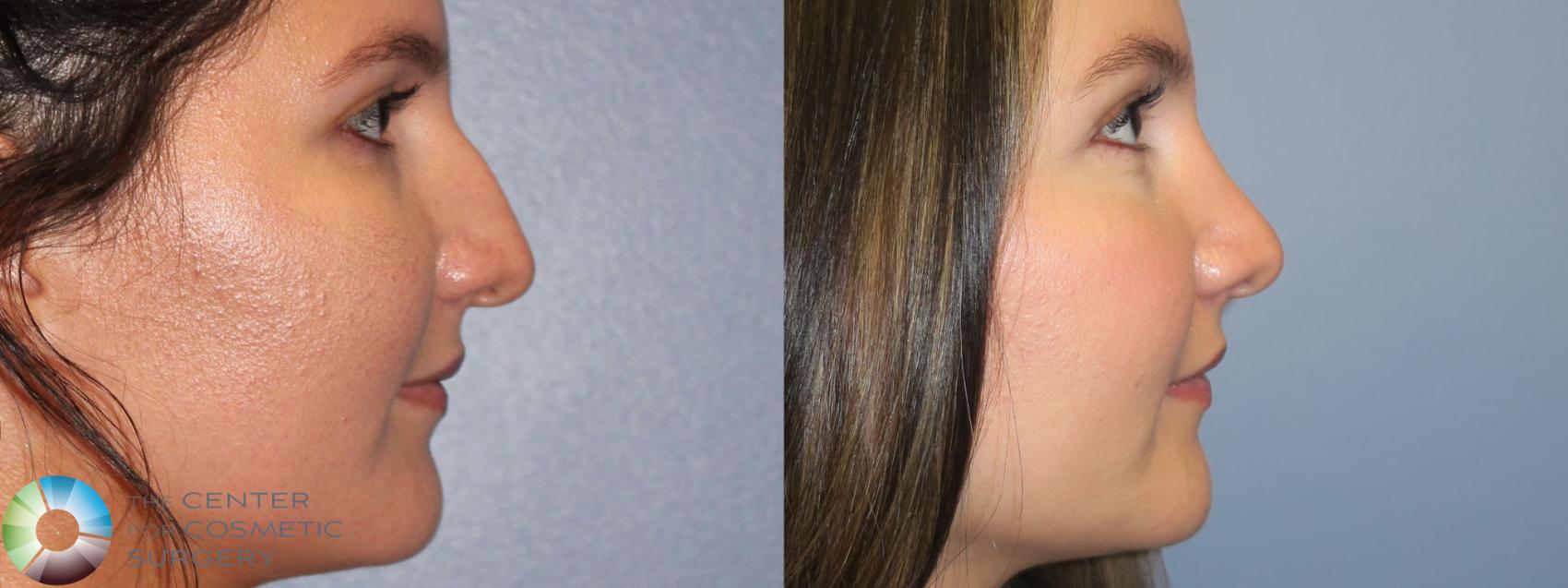 Before & After Rhinoplasty Case 11658 Right Side in Denver and Colorado Springs, CO