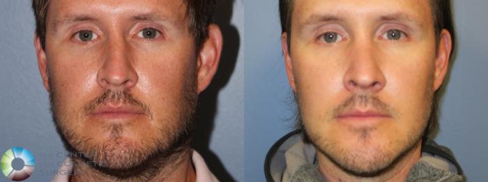 Before & After Rhinoplasty Case 11667 Front in Denver and Colorado Springs, CO