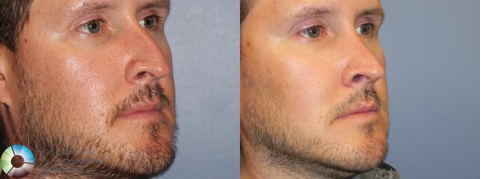 Before & After Rhinoplasty Case 11667 Right Oblique in Denver and Colorado Springs, CO