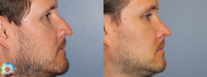 Before & After Rhinoplasty Case 11667 Right Side in Denver and Colorado Springs, CO