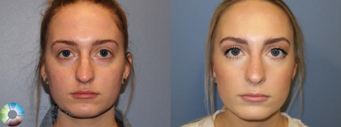 Before & After Rhinoplasty Case 11785 Front View in Golden, CO