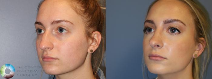 Before & After Rhinoplasty Case 11785 Left Oblique View in Golden, CO