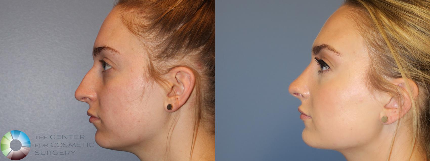 Before & After Rhinoplasty Case 11785 Left Side View in Golden, CO