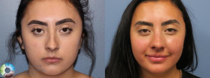 Before & After Rhinoplasty Case 11786 Front View in Golden, CO
