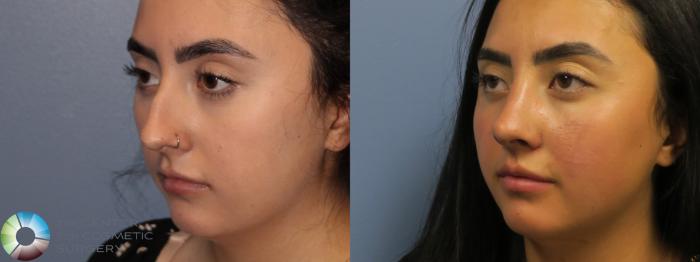 Before & After Rhinoplasty Case 11786 Left Oblique View in Golden, CO