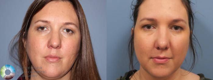 Before & After Rhinoplasty Case 11787 Front in Denver and Colorado Springs, CO