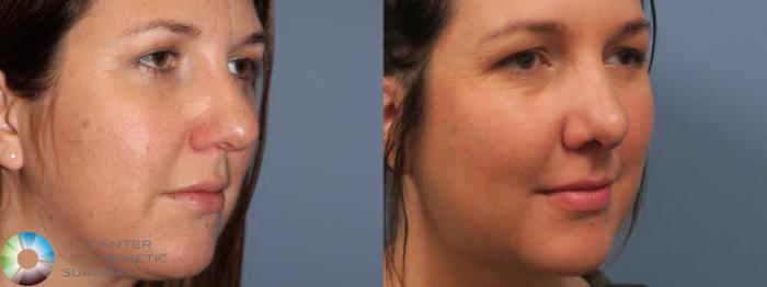 Before & After Rhinoplasty Case 11787 Right Oblique in Denver and Colorado Springs, CO