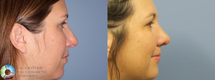 Before & After Rhinoplasty Case 11787 Right Side in Denver and Colorado Springs, CO