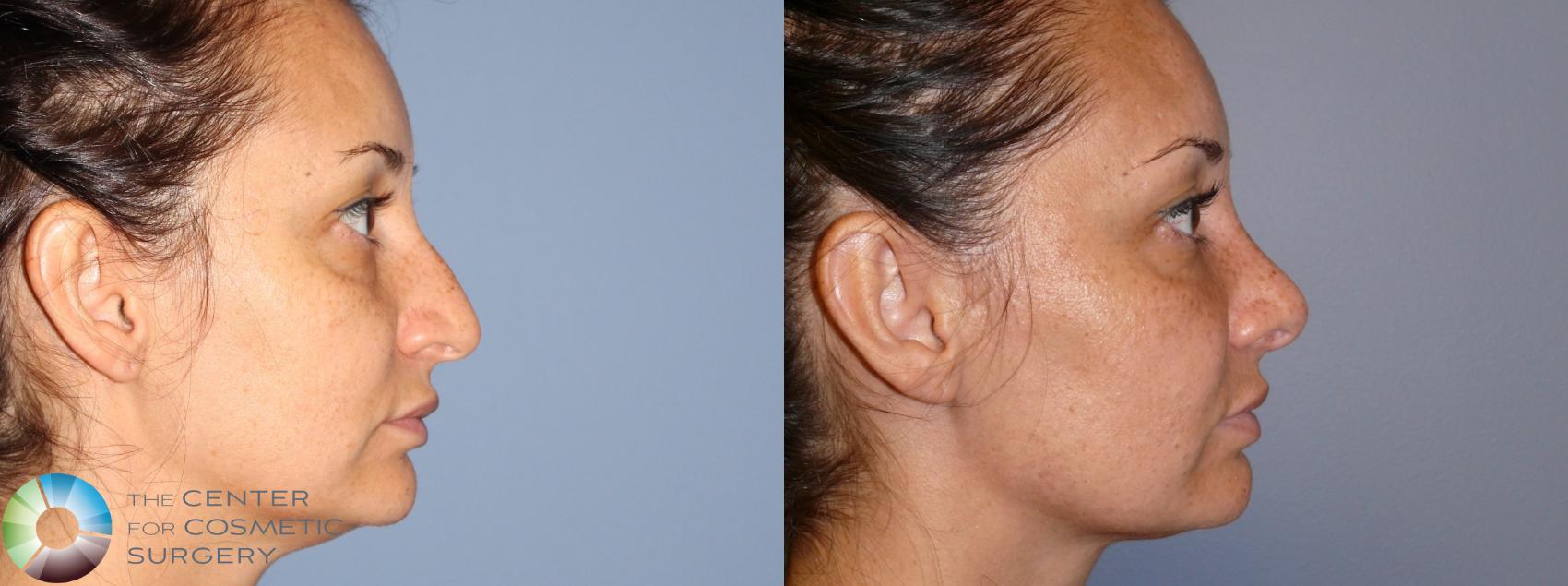 Before & After Rhinoplasty Case 11788 Right Side in Denver and Colorado Springs, CO