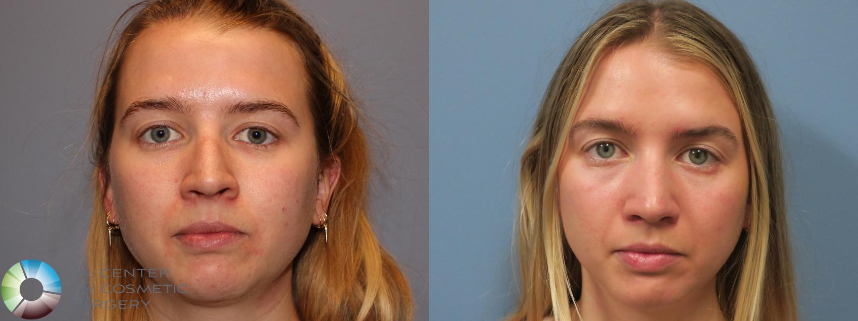 Before & After Rhinoplasty Case 11862 Front in Denver and Colorado Springs, CO