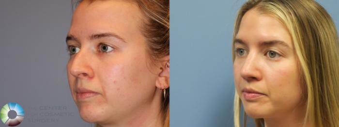 Before & After Rhinoplasty Case 11862 Left Oblique View in Golden, CO