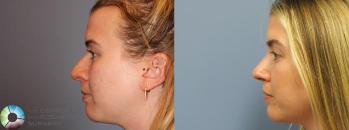 Before & After Rhinoplasty Case 11862 Left Side View in Golden, CO