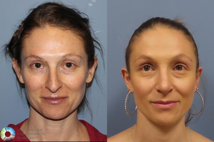 Before & After Rhinoplasty Case 12026 Front in Denver and Colorado Springs, CO