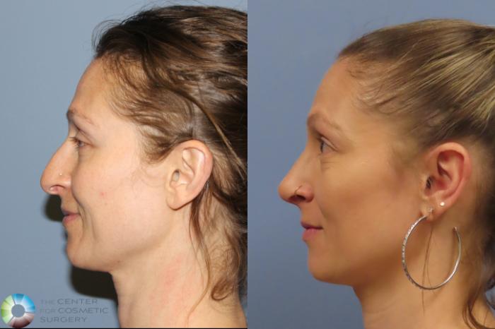 Before & After Rhinoplasty Case 12026 Left Side in Denver and Colorado Springs, CO