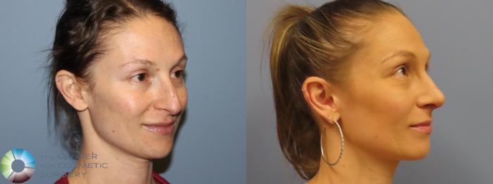 Before & After Rhinoplasty Case 12026 Right Oblique in Denver and Colorado Springs, CO