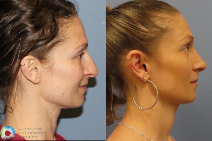 Before & After Rhinoplasty Case 12026 Right Side in Denver and Colorado Springs, CO