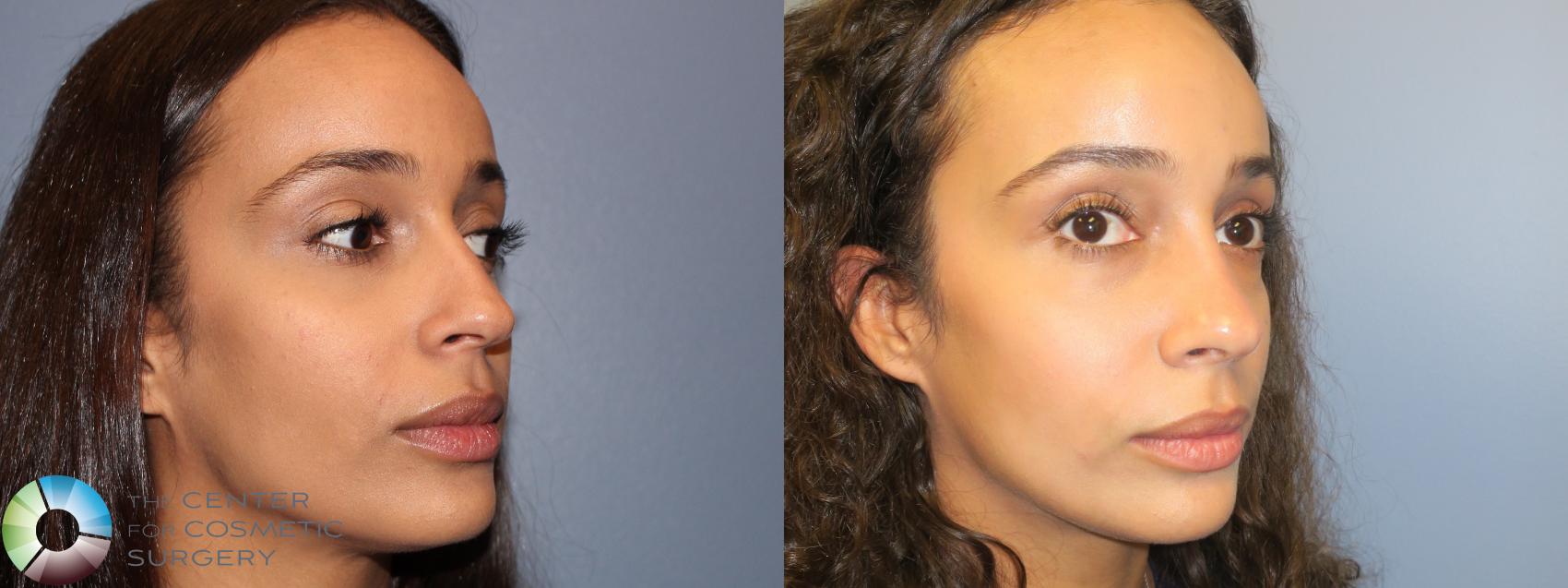 Before & After Rhinoplasty Case 12081 Right Oblique in Denver and Colorado Springs, CO